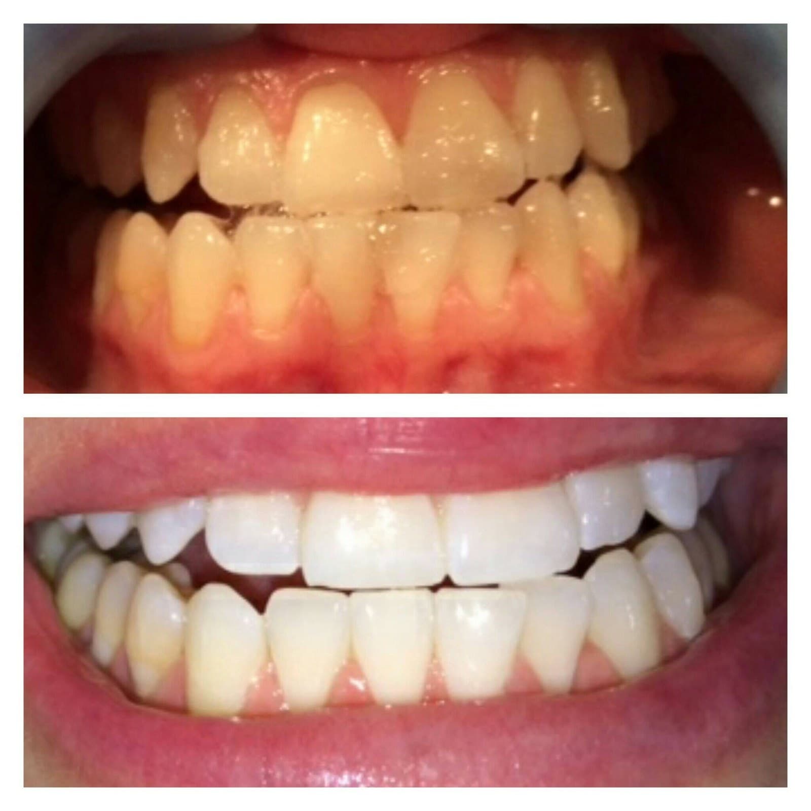 Top: teeth before laser whitening. Bottom: the same teeth after.