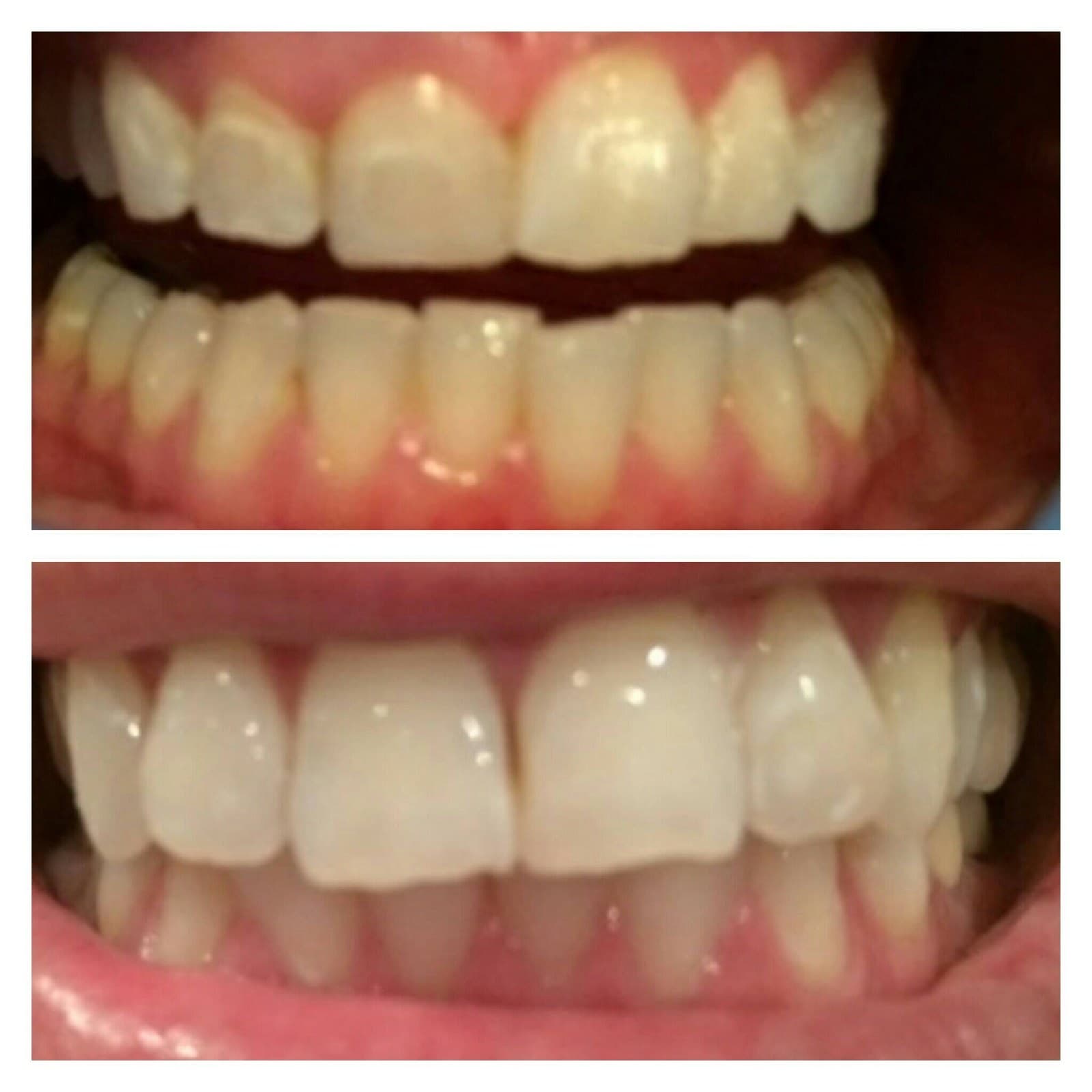 Top: teeth before laser whitening. Bottom: the same teeth after.